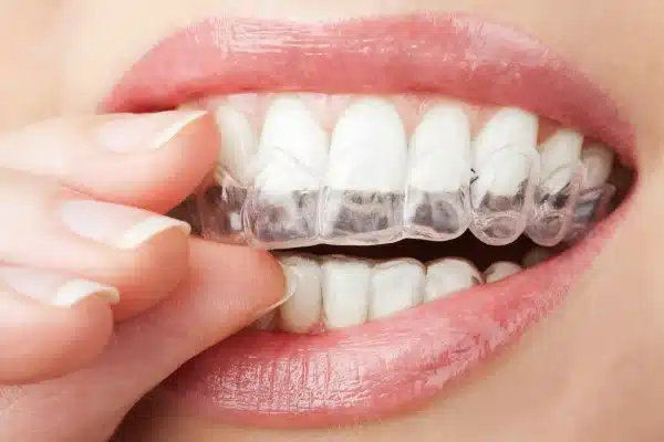 invisalign.jpg
